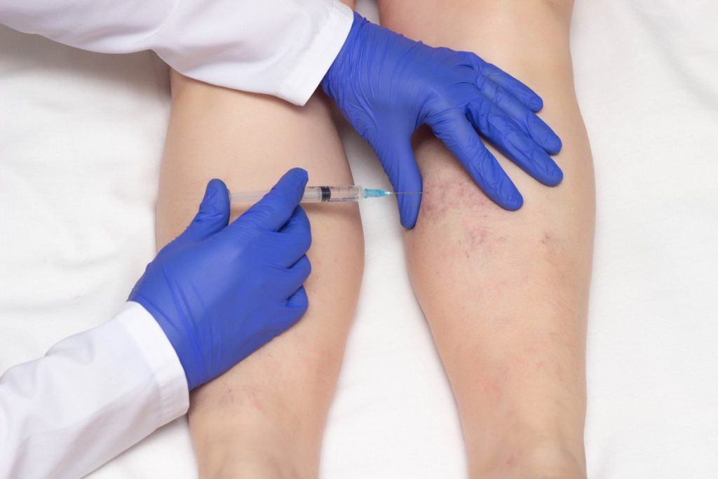 Spider Veins