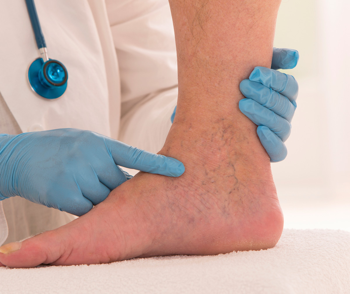 Spider-Veins-Prevented - Southernmost Foot & Ankle Specialists