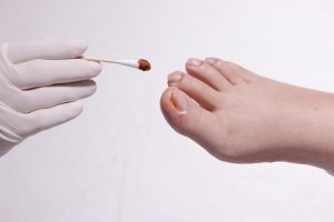 Hand of podiatrist treating ingrown toenail.
