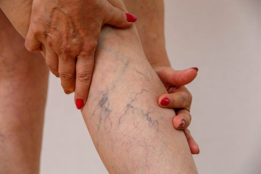 Close-up Of Hands Examining Varicose Veins On A Leg With Red Nail Polish.