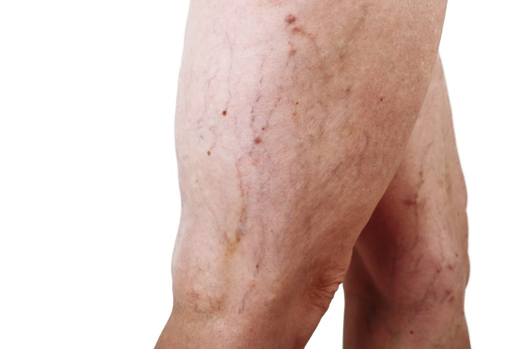 Close-up Of A Woman’s Leg With Visible Spider Veins And Early Varicose Veins, Showcasing Vein Discoloration And Mild Skin Irregularities.