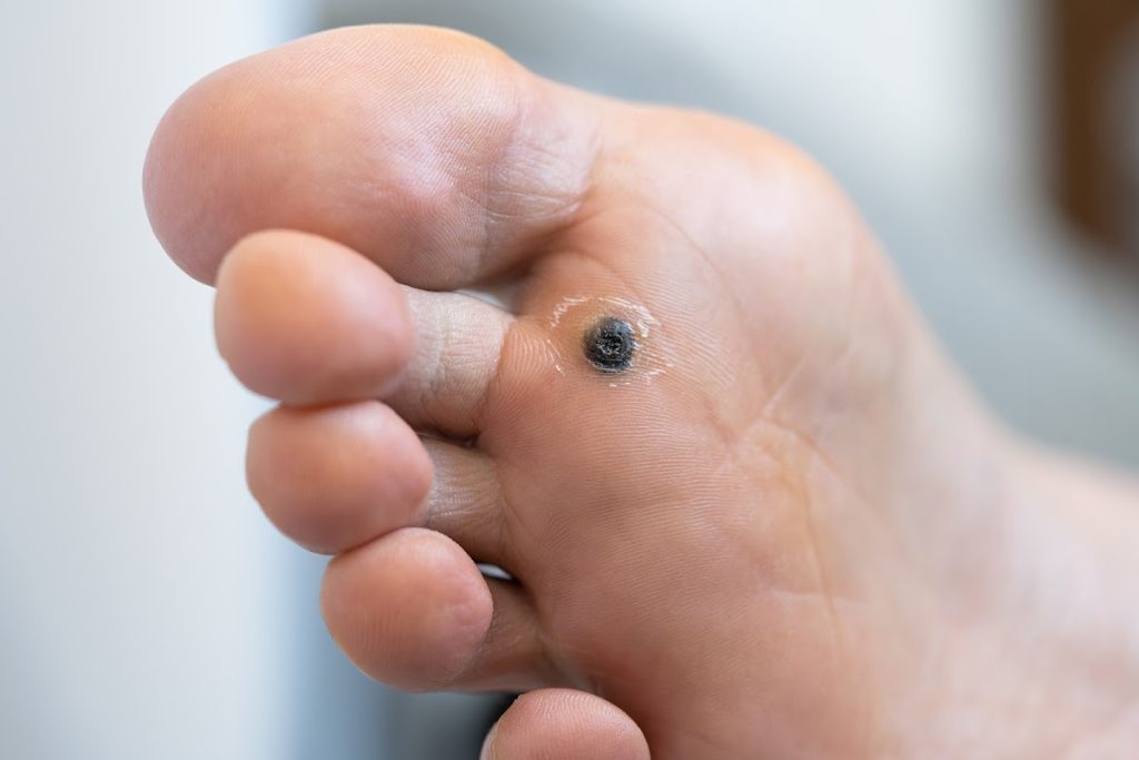 Close-up Of Plantar Wart After Cauterization Treatment